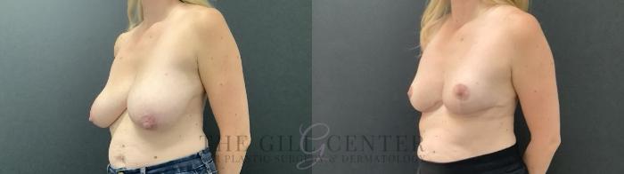 Breast Reduction Case 700 Before & After Left Side | The Woodlands, TX | The Gill Center for Plastic Surgery and Dermatology
