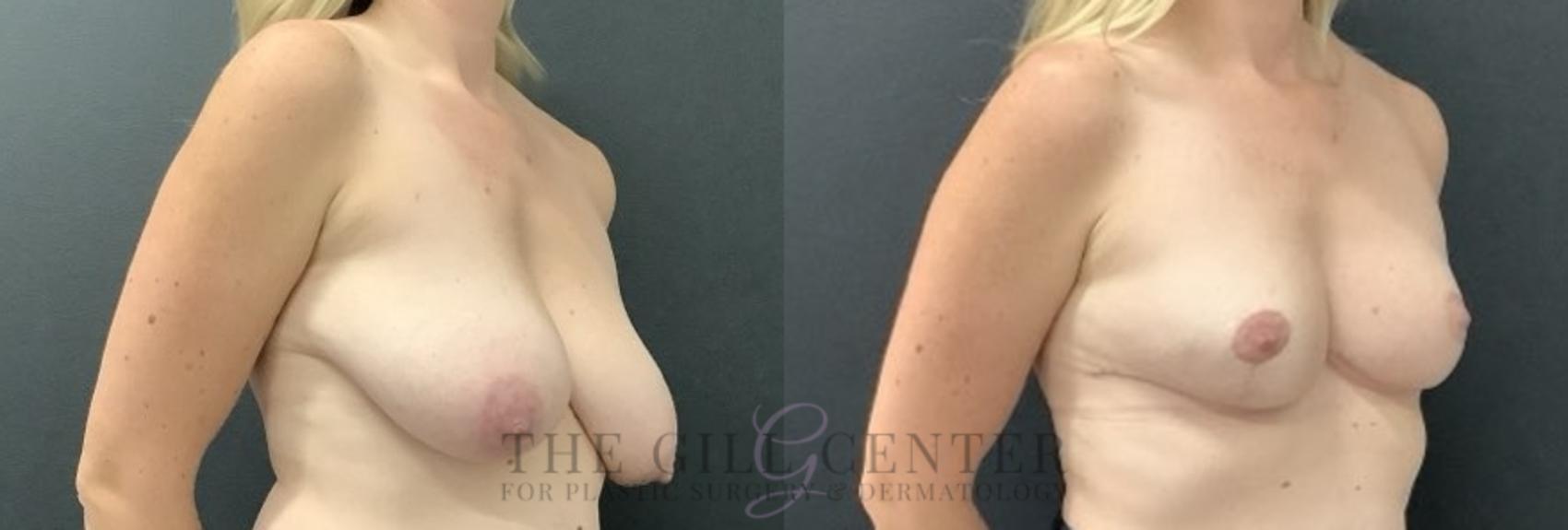 Breast Reduction Case 700 Before & After Right Side | The Woodlands, TX | The Gill Center for Plastic Surgery and Dermatology