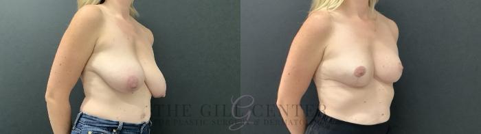 Breast Reduction Case 700 Before & After Right Side | The Woodlands, TX | The Gill Center for Plastic Surgery and Dermatology