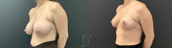 Breast Reduction Case 702 Before & After Left Side | The Woodlands, TX | The Gill Center for Plastic Surgery and Dermatology