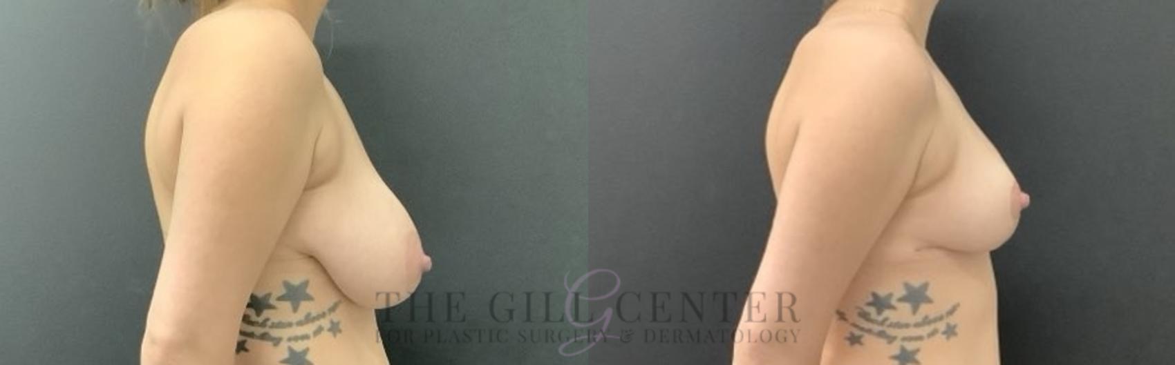 Breast Reduction Case 702 Before & After Right Oblique | The Woodlands, TX | The Gill Center for Plastic Surgery and Dermatology