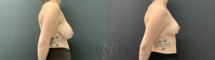 Breast Reduction Case 702 Before & After Right Oblique | The Woodlands, TX | The Gill Center for Plastic Surgery and Dermatology