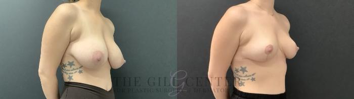 Breast Reduction Case 702 Before & After Right Side | The Woodlands, TX | The Gill Center for Plastic Surgery and Dermatology