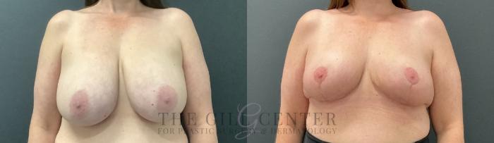 Breast Reduction Case 720 Before & After Front | The Woodlands, TX | The Gill Center for Plastic Surgery and Dermatology