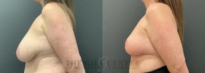 Breast Reduction Case 720 Before & After Left Side | The Woodlands, TX | The Gill Center for Plastic Surgery and Dermatology