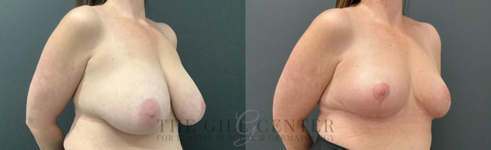 Breast Reduction Case 720 Before & After Right Oblique | The Woodlands, TX | The Gill Center for Plastic Surgery and Dermatology
