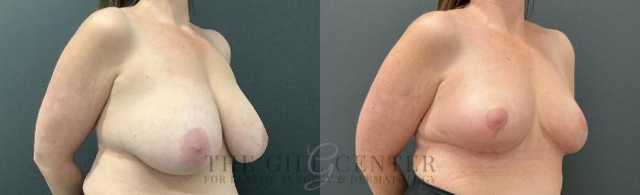 Breast Reduction Case 720 Before & After Right Oblique | The Woodlands, TX | The Gill Center for Plastic Surgery and Dermatology