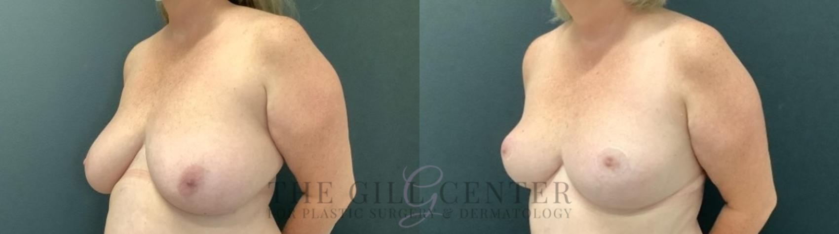 Breast Reduction Case 749 Before & After Left Oblique | The Woodlands, TX | The Gill Center for Plastic Surgery and Dermatology