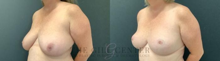 Breast Reduction Case 749 Before & After Left Oblique | The Woodlands, TX | The Gill Center for Plastic Surgery and Dermatology