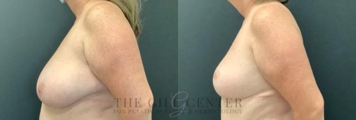 Breast Reduction Case 749 Before & After Left Side | The Woodlands, TX | The Gill Center for Plastic Surgery and Dermatology