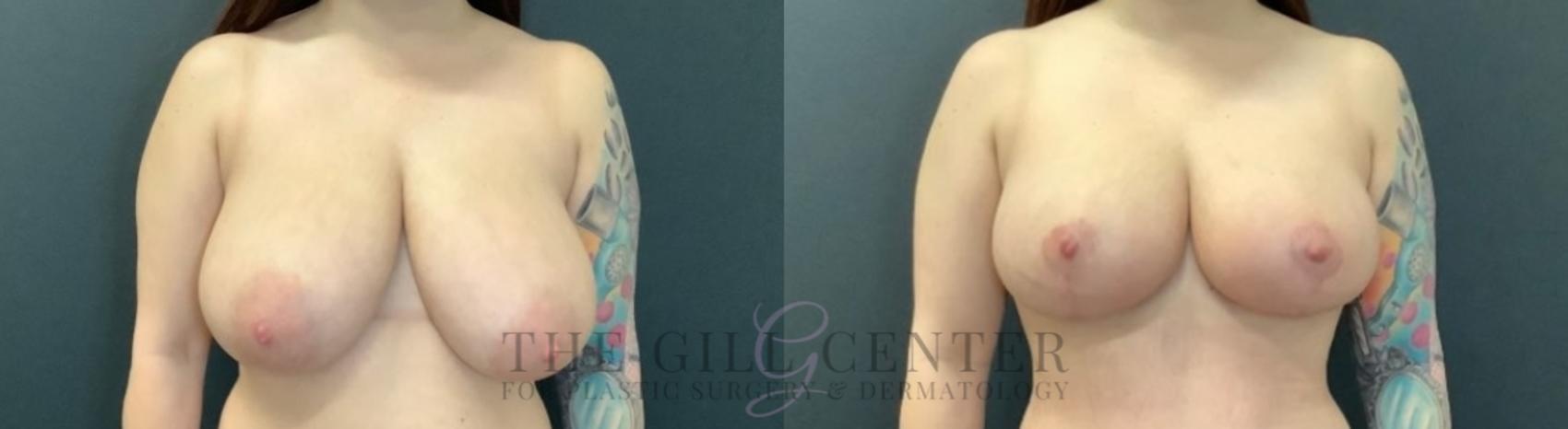 Breast Reduction Case 750 Before & After Front | The Woodlands, TX | The Gill Center for Plastic Surgery and Dermatology