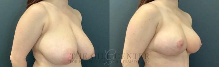 Breast Reduction Case 750 Before & After Right Oblique | The Woodlands, TX | The Gill Center for Plastic Surgery and Dermatology