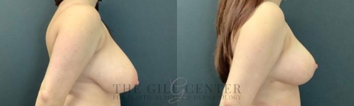 Breast Reduction Case 750 Before & After Right Side | The Woodlands, TX | The Gill Center for Plastic Surgery and Dermatology