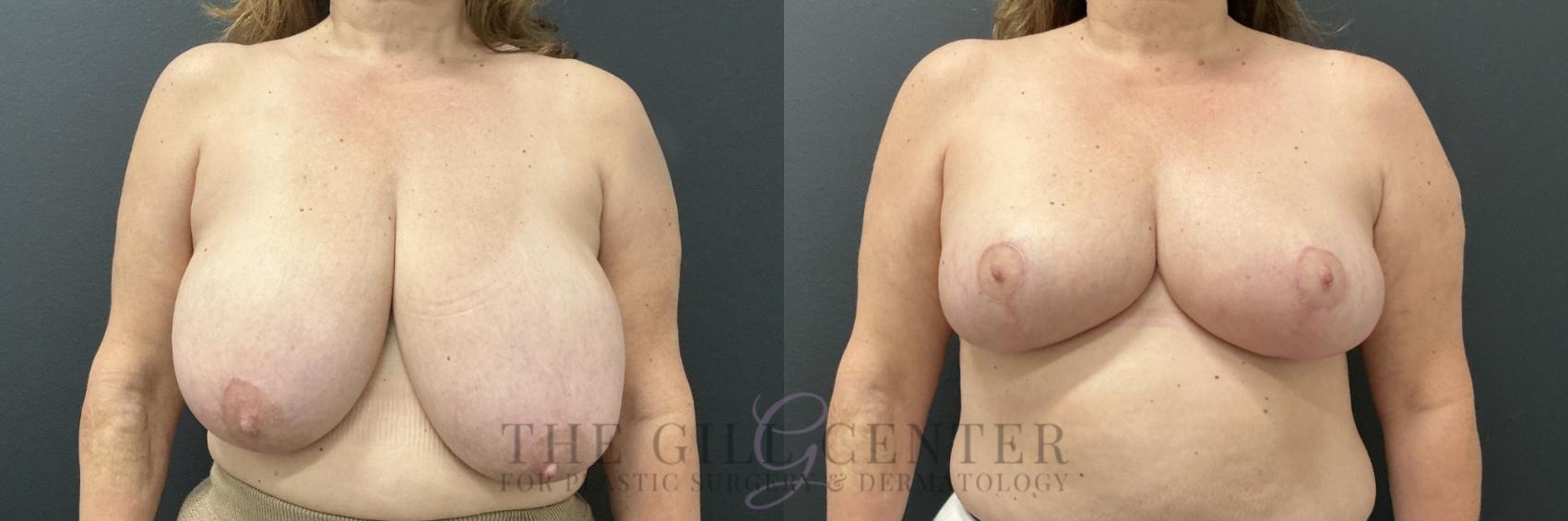 Breast Reduction Case 765 Before & After Front | The Woodlands, TX | The Gill Center for Plastic Surgery and Dermatology