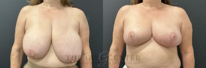 Breast Reduction Case 765 Before & After Front | The Woodlands, TX | The Gill Center for Plastic Surgery and Dermatology