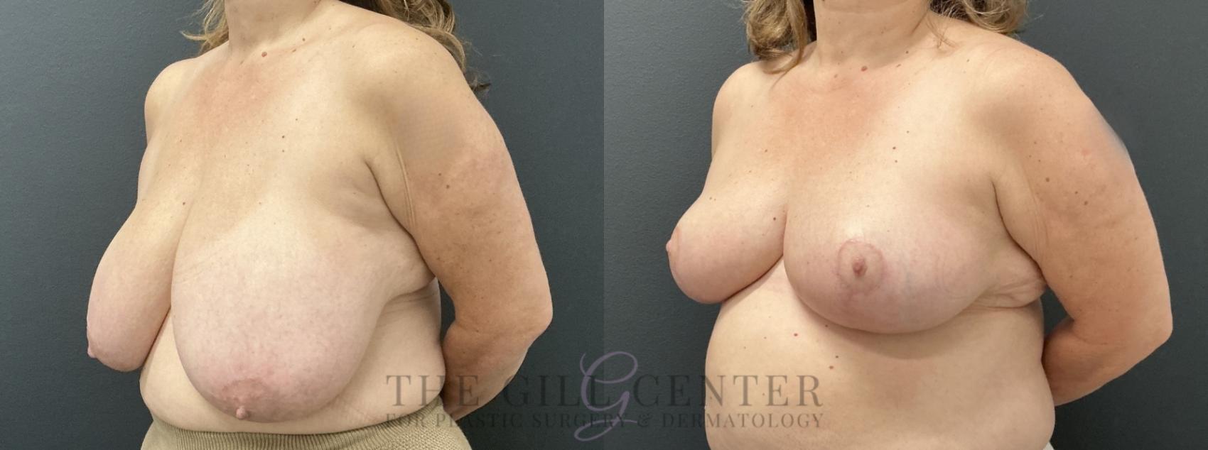 Breast Reduction Case 765 Before & After Left Oblique | The Woodlands, TX | The Gill Center for Plastic Surgery and Dermatology