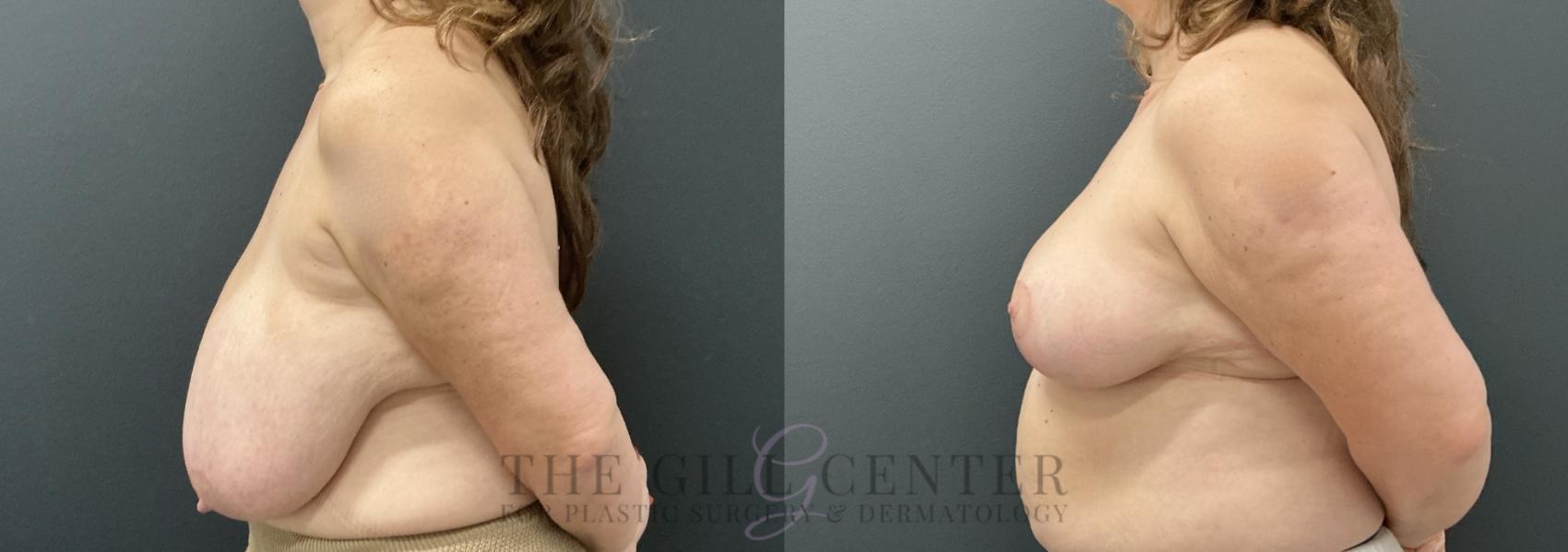 Breast Reduction Case 765 Before & After Left Side | The Woodlands, TX | The Gill Center for Plastic Surgery and Dermatology