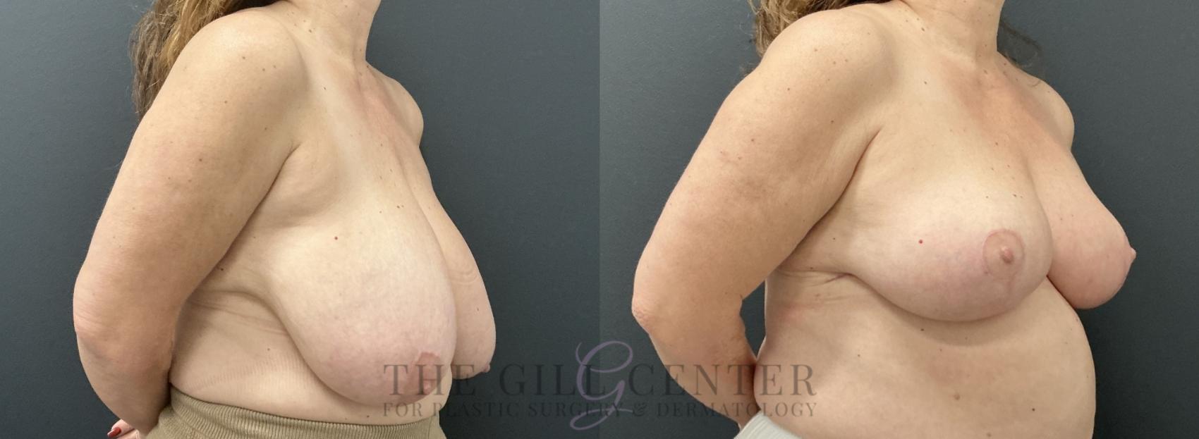Breast Reduction Case 765 Before & After Right Oblique | The Woodlands, TX | The Gill Center for Plastic Surgery and Dermatology