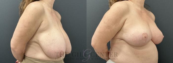 Breast Reduction Case 765 Before & After Right Oblique | The Woodlands, TX | The Gill Center for Plastic Surgery and Dermatology