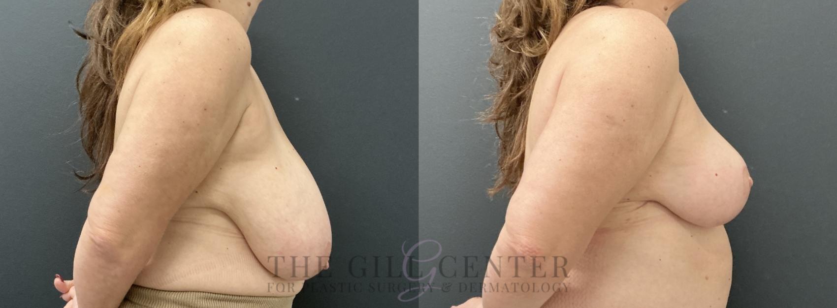 Breast Reduction Case 765 Before & After Right Side | The Woodlands, TX | The Gill Center for Plastic Surgery and Dermatology