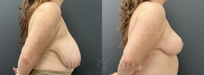 Breast Reduction Case 765 Before & After Right Side | The Woodlands, TX | The Gill Center for Plastic Surgery and Dermatology