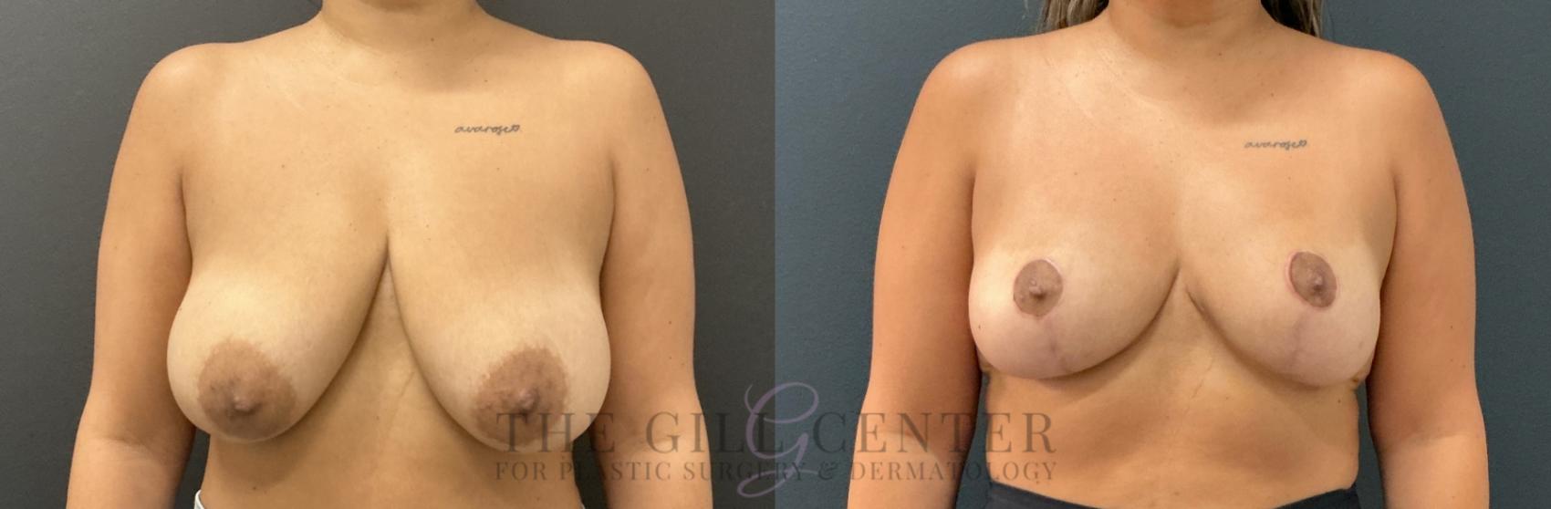Breast Reduction Case 802 Before & After Front | The Woodlands, TX | The Gill Center for Plastic Surgery and Dermatology