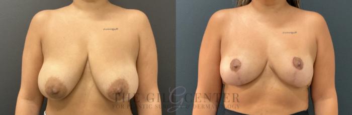 Breast Reduction Case 802 Before & After Front | The Woodlands, TX | The Gill Center for Plastic Surgery and Dermatology