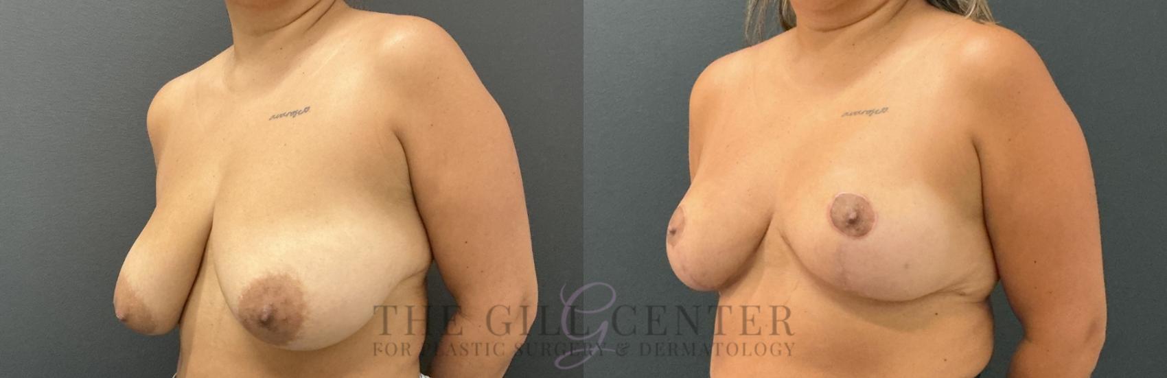 Breast Reduction Case 802 Before & After Left Oblique | The Woodlands, TX | The Gill Center for Plastic Surgery and Dermatology