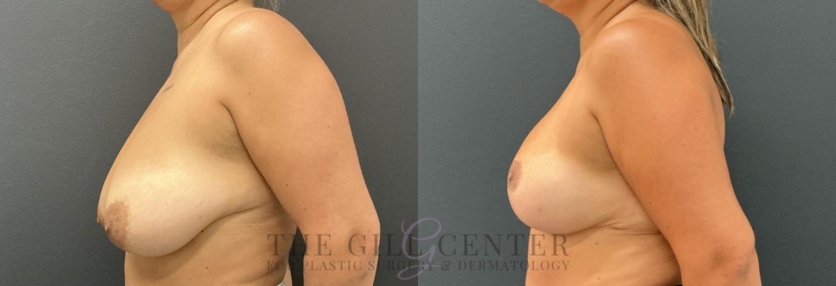Breast Reduction Case 802 Before & After Left Side | The Woodlands, TX | The Gill Center for Plastic Surgery and Dermatology