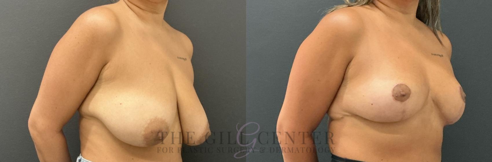 Breast Reduction Case 802 Before & After Right Oblique | The Woodlands, TX | The Gill Center for Plastic Surgery and Dermatology