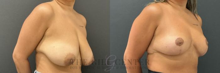 Breast Reduction Case 802 Before & After Right Oblique | The Woodlands, TX | The Gill Center for Plastic Surgery and Dermatology