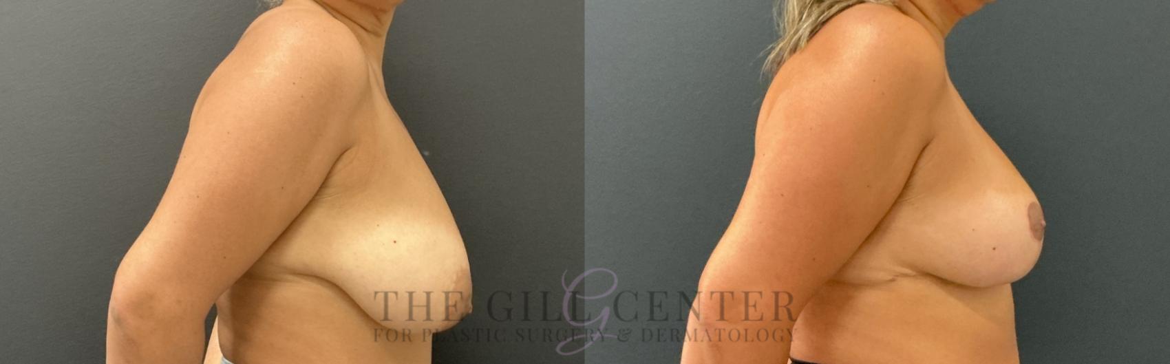 Breast Reduction Case 802 Before & After Right Side | The Woodlands, TX | The Gill Center for Plastic Surgery and Dermatology