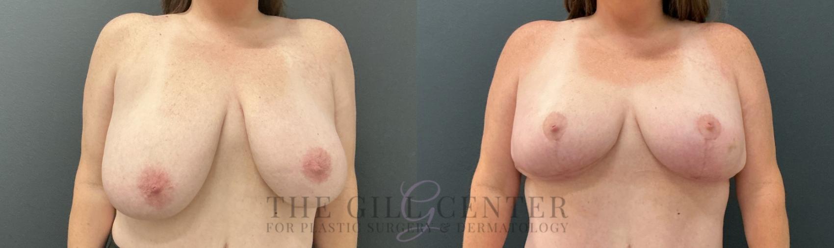 Breast Reduction Case 811 Before & After Front | The Woodlands, TX | The Gill Center for Plastic Surgery and Dermatology