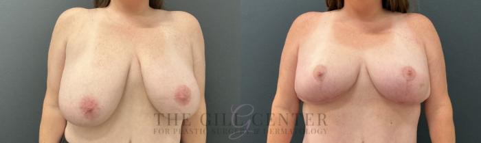 Breast Reduction Case 811 Before & After Front | The Woodlands, TX | The Gill Center for Plastic Surgery and Dermatology