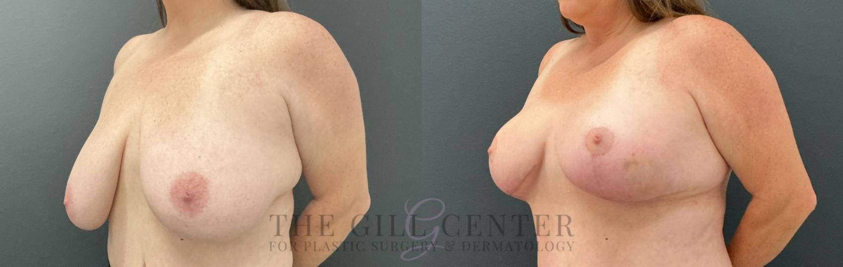 Breast Reduction Case 811 Before & After Left Oblique | The Woodlands, TX | The Gill Center for Plastic Surgery and Dermatology