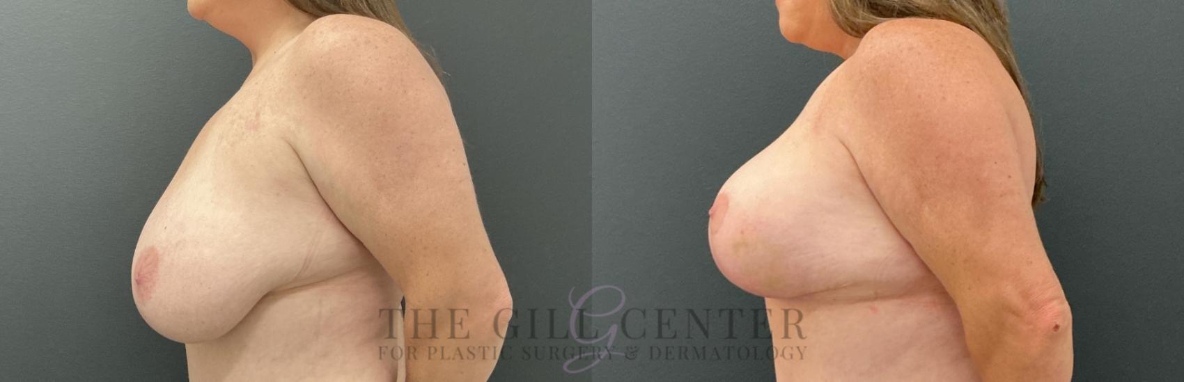 Breast Reduction Case 811 Before & After Left Side | The Woodlands, TX | The Gill Center for Plastic Surgery and Dermatology