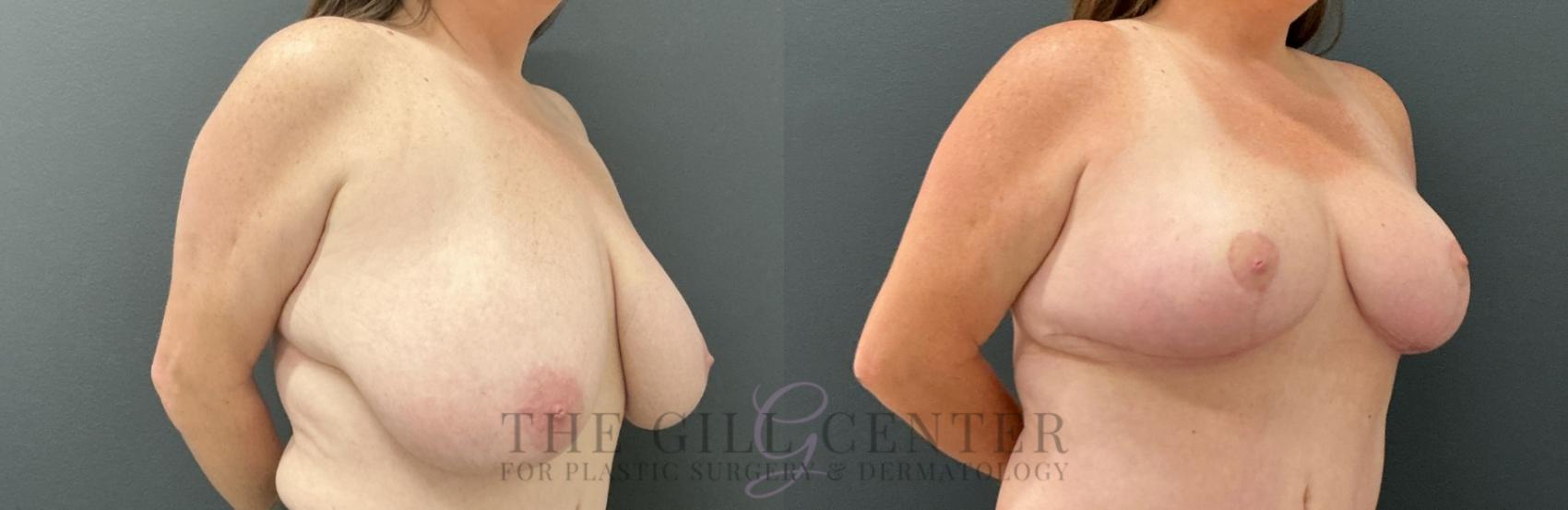 Breast Reduction Case 811 Before & After Right Oblique | The Woodlands, TX | The Gill Center for Plastic Surgery and Dermatology