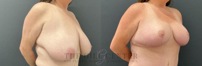 Breast Reduction Case 811 Before & After Right Oblique | The Woodlands, TX | The Gill Center for Plastic Surgery and Dermatology