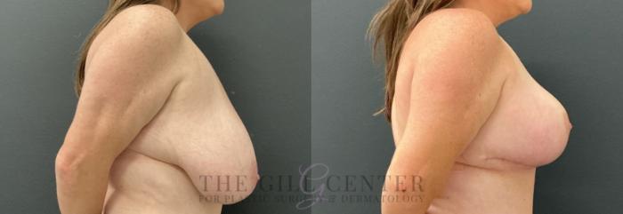 Breast Reduction Case 811 Before & After Right Side | The Woodlands, TX | The Gill Center for Plastic Surgery and Dermatology