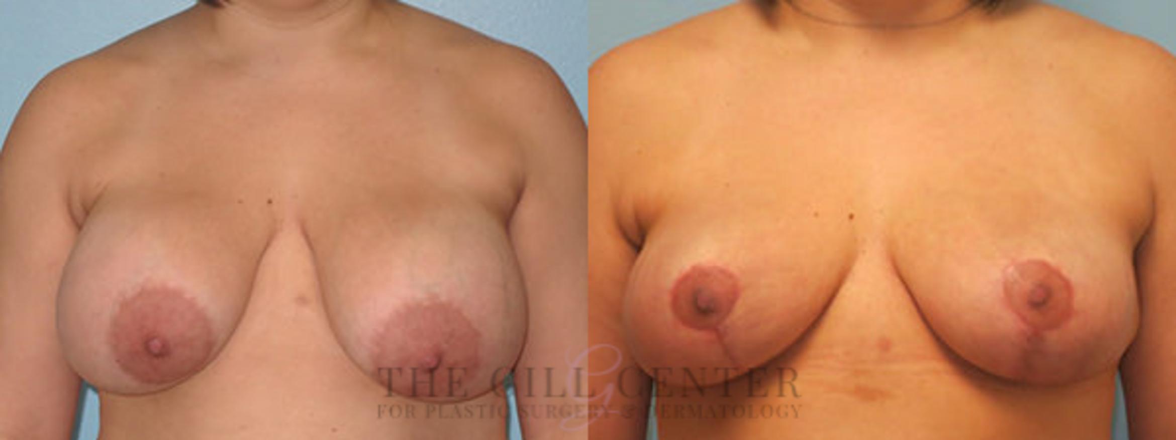 Breast Revision Case 378 Before & After Front | The Woodlands, TX | The Gill Center for Plastic Surgery and Dermatology