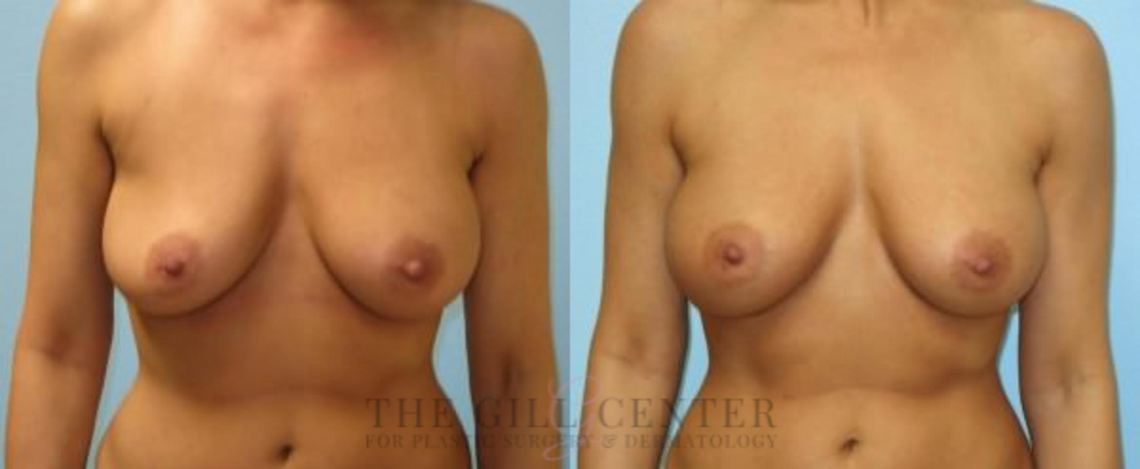 Breast Revision Case 381 Before & After Front | The Woodlands, TX | The Gill Center for Plastic Surgery and Dermatology