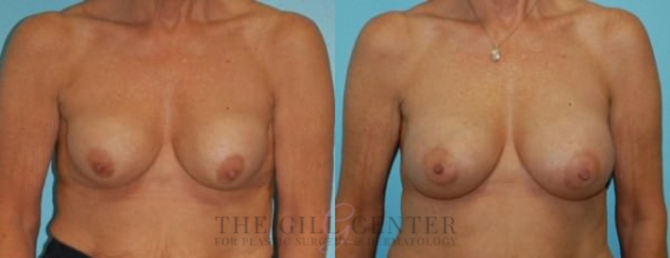 Breast Revision Case 383 Before & After Front | The Woodlands, TX | The Gill Center for Plastic Surgery and Dermatology