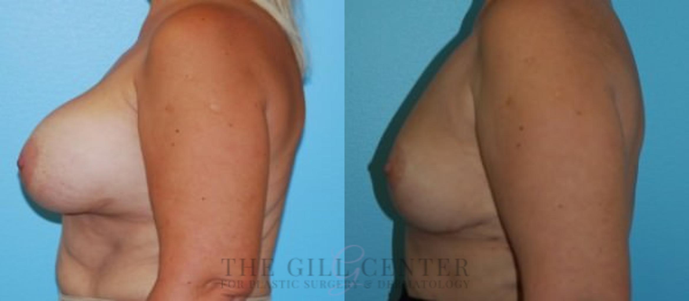 Breast Revision Case 384 Before & After Left Side | The Woodlands, TX | The Gill Center for Plastic Surgery and Dermatology