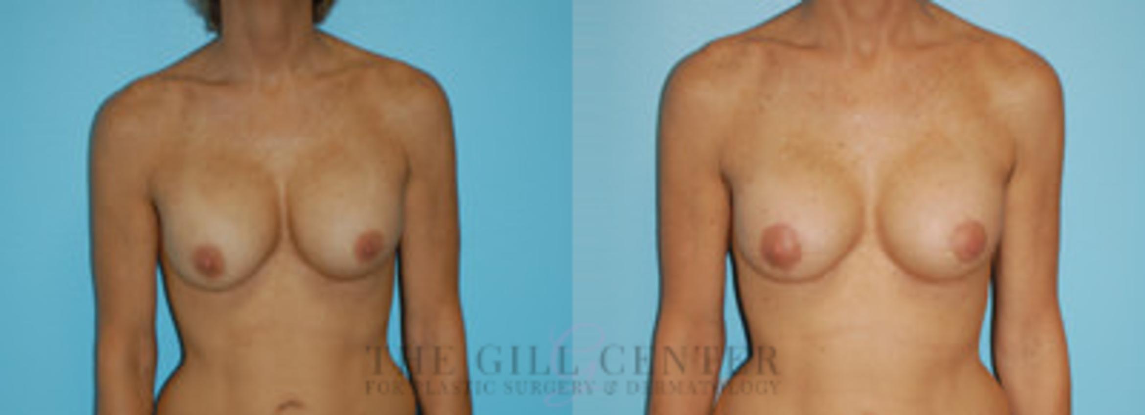 Breast Revision Case 385 Before & After Front | The Woodlands, TX | The Gill Center for Plastic Surgery and Dermatology
