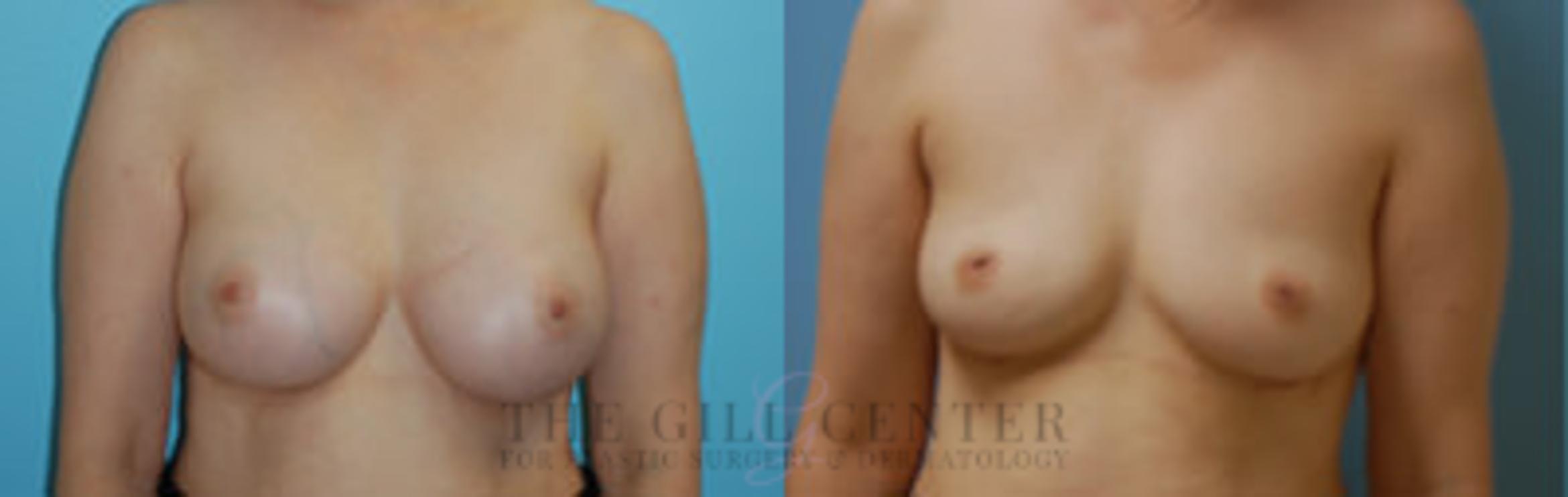 Breast Revision Case 386 Before & After Front | The Woodlands, TX | The Gill Center for Plastic Surgery and Dermatology