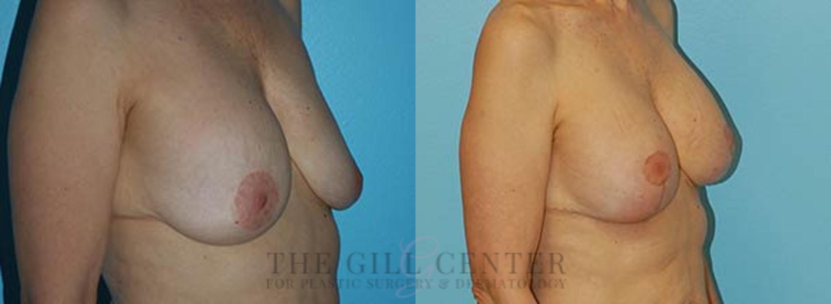 Breast Revisions Case 112 Before & After Right Oblique | The Woodlands, TX | The Gill Center for Plastic Surgery and Dermatology