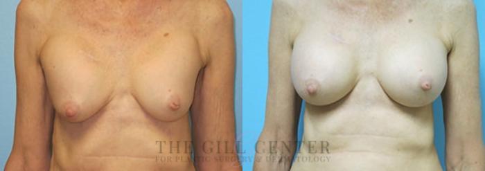 Breast Revisions Case 351 Before & After Front | The Woodlands, TX | The Gill Center for Plastic Surgery and Dermatology