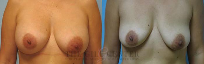 Breast Revisions Case 361 Before & After Front | The Woodlands, TX | The Gill Center for Plastic Surgery and Dermatology