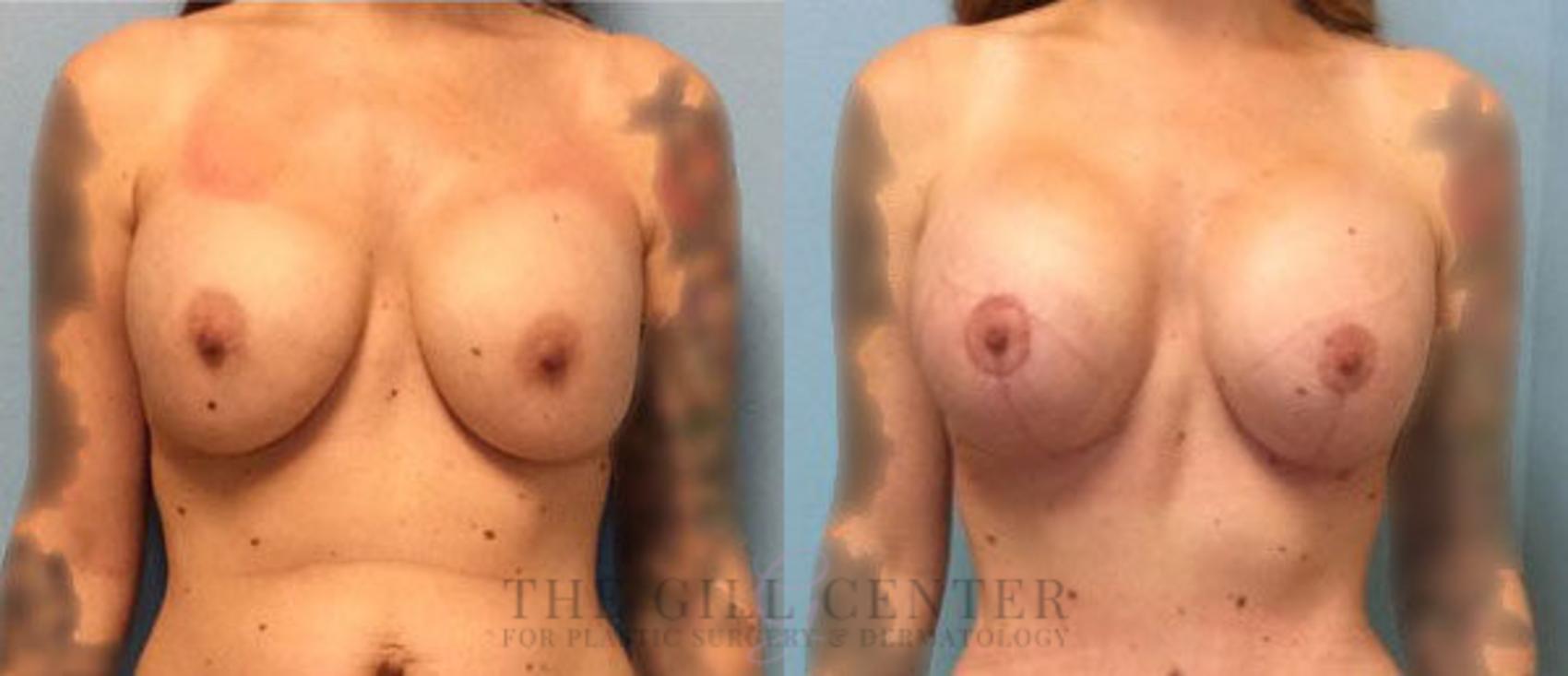 Breast Revisions Case 376 Before & After Front | The Woodlands, TX | The Gill Center for Plastic Surgery and Dermatology