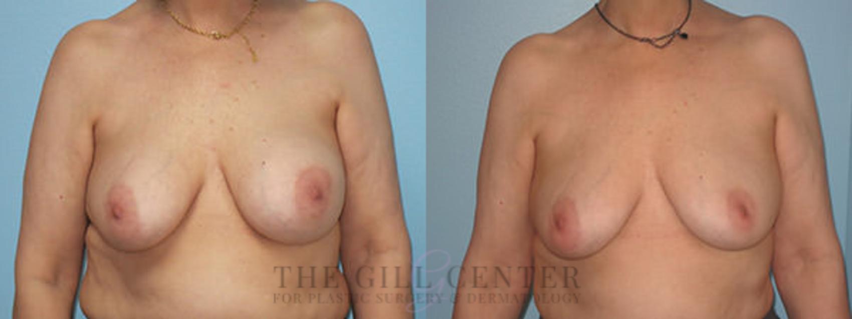 Breast Revisions Case 377 Before & After Front | The Woodlands, TX | The Gill Center for Plastic Surgery and Dermatology